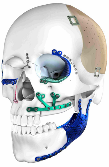 Facial skull with medical implants